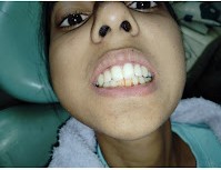 Braces Treatment